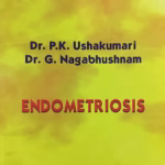 endometriosis