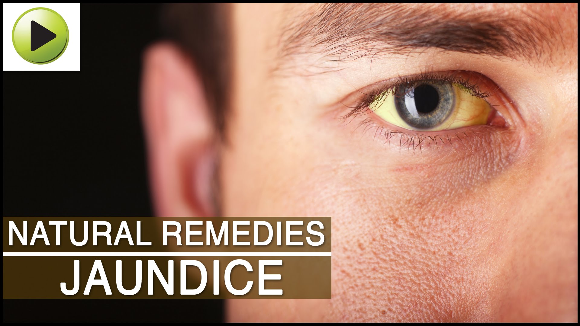 Jaundice - Rajved